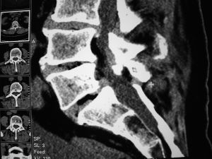 CT unterstützte Schmerztherapie CT unterstützte Schmerztherapie